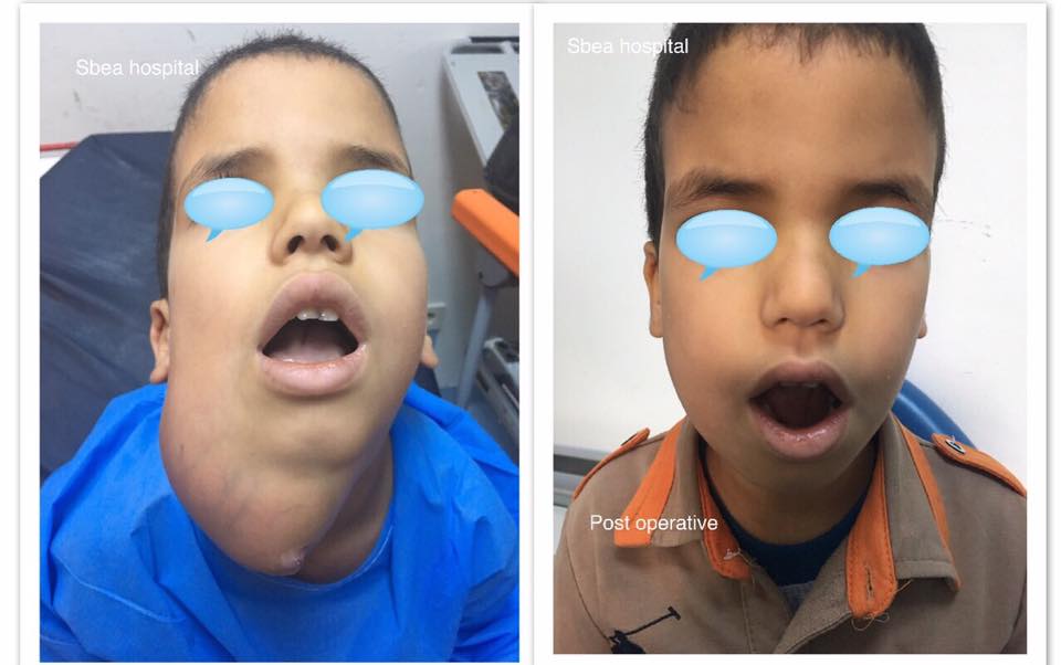 استئصال ورم من طفل مستشفى السبيعة